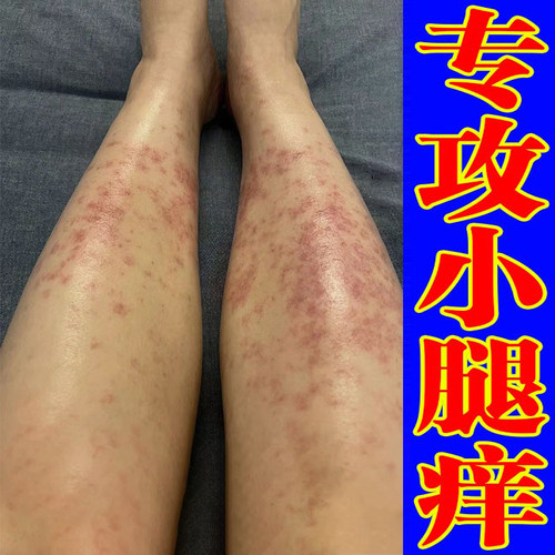 夏天小腿天热腿部长疙瘩红点红斑腿上红肿疙瘩软膏