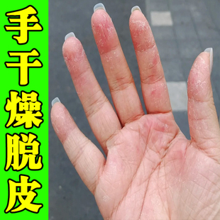 儿童手脱皮脱皮专用季节性手指头蜕皮皴裂开裂口外用乳膏