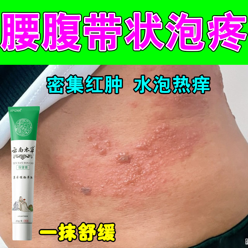 红泡带状盘腰上汗水疙瘩后遗症红肿刺痛灼热神经疼草本修护膏乳