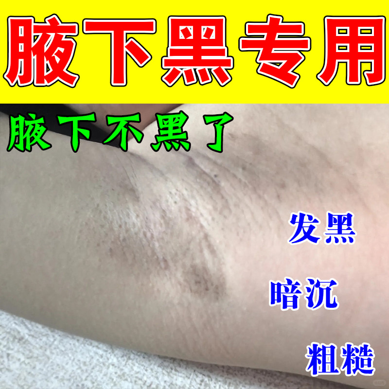 改善腋窝暗沉胳肢窝肤色发黑腋下褶皱粗糙腋下色素堆积按摩修护膏