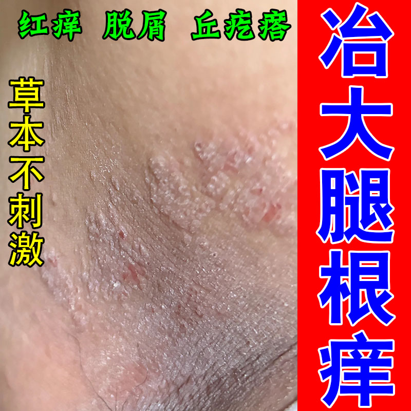 冶腿部内侧干痒疙瘩痒起红斑长红点粗糙挠痒干燥红疙瘩专用膏