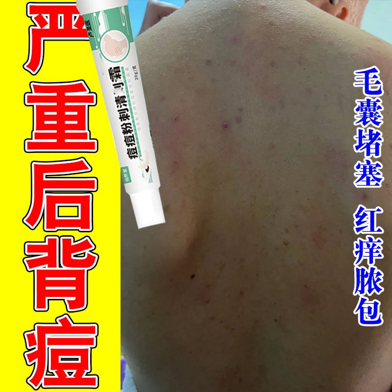 背上长痘真菌后背毛囊后背疙瘩疙瘩红肿粗糙疙瘩发红草本修护膏