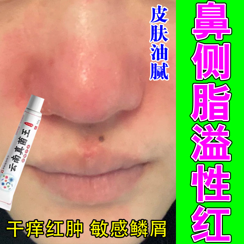 脂溢性鼻侧红痒干皮掉皮屑粗糙干燥鼻翼泛红出油粗糙植物萃取软膏
