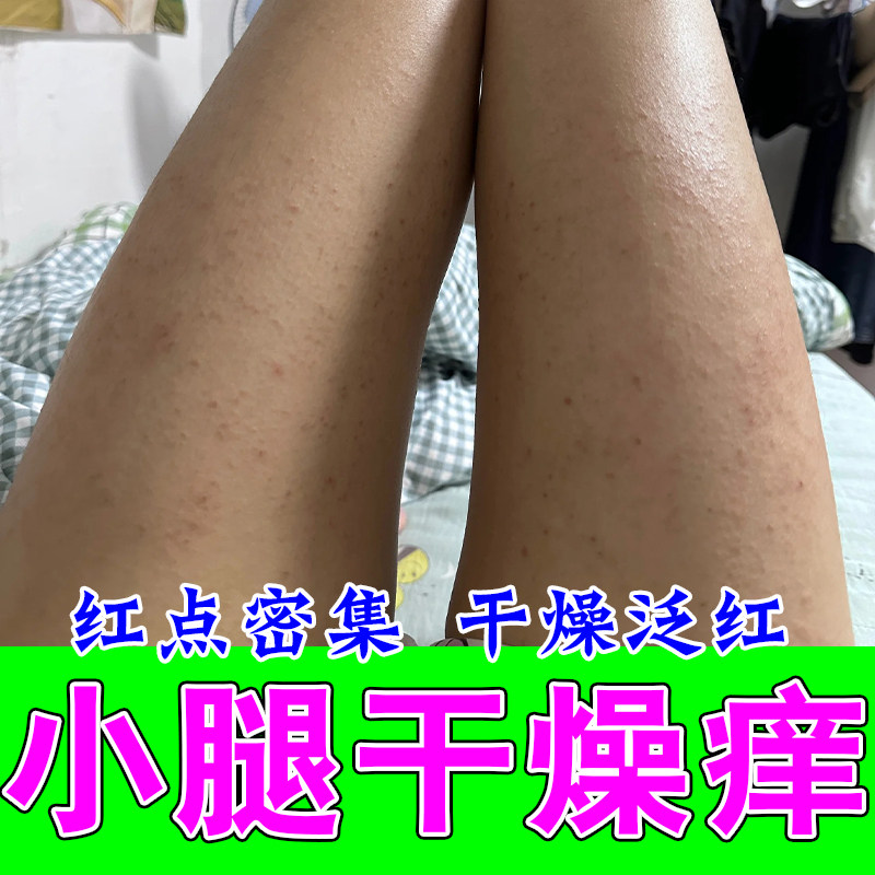腿上干性疙瘩皮肤干糙起疙瘩红点起皮掉屑红点疙瘩过敏舒缓软膏