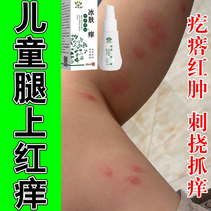 小孩身上被咬红疙瘩蚊虫螨虫叮咬小疙瘩发红草本温和萃取喷剂