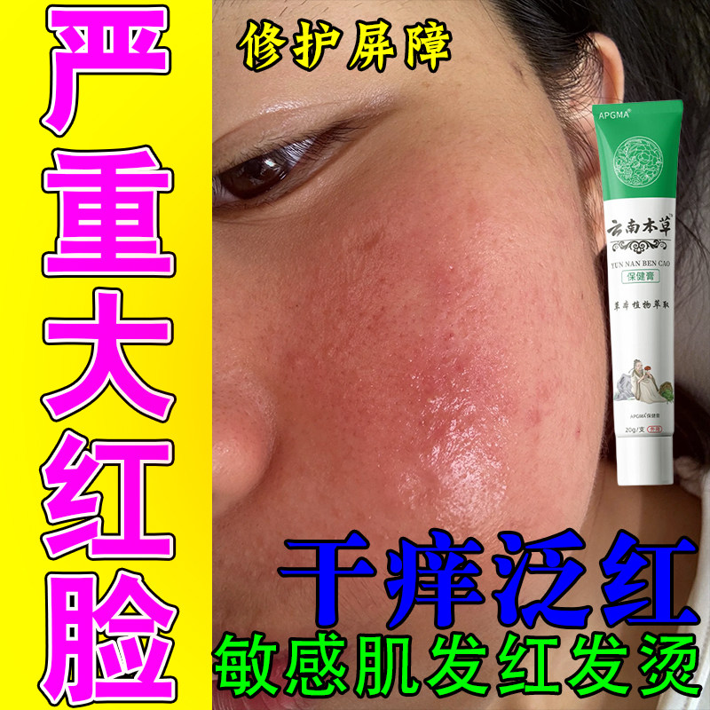 脸部泛红过敏痒红肿刺痛起皮春秋过敏变红植物萃取修护膏