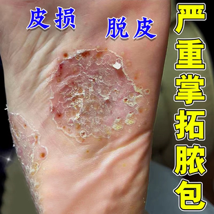 掌趾脓疱病专用掌跖角化症手脚脓包蜕皮干裂角皮症外用膏
