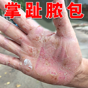 掌趾脓疱病专用膏掌跖脓包角化病症手脚脱皮干裂角皮症