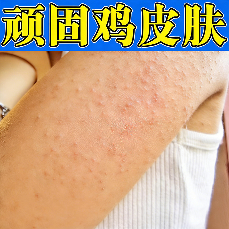 去胳膊鸡皮毛囊角质化小颗粒身上鸡皮疙瘩腿上鸡皮修复毛周角化