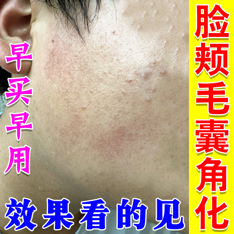 儿童脸上有小颗粒脸部起小疙瘩脸颊两边痘鸡皮疙瘩闭口粉刺痒