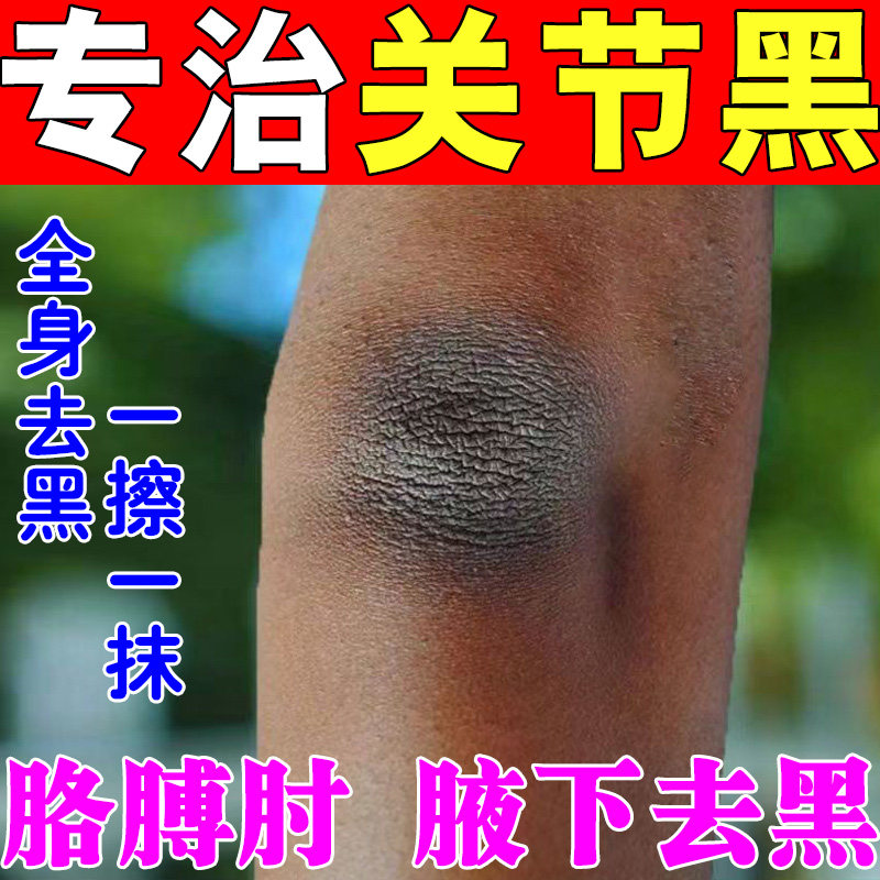 关节神器儿童腋下脖子黑黑的黑棘皮症黑色素沉淀