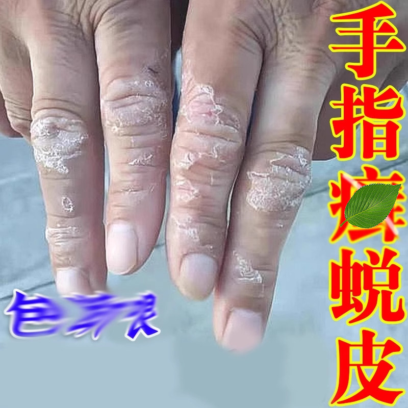 关节性顽固手指关节真菌手背关节起痒专用