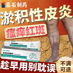 静脉曲张淤积性皮炎小腿皮肤瘙痒湿疹静脉炎发黑溃烂药房同款膏BS
