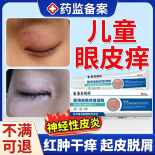眼皮癣红肿干痒眼睛周围眼皮过敏发痒可搭药膏眼角神经性皮炎EM