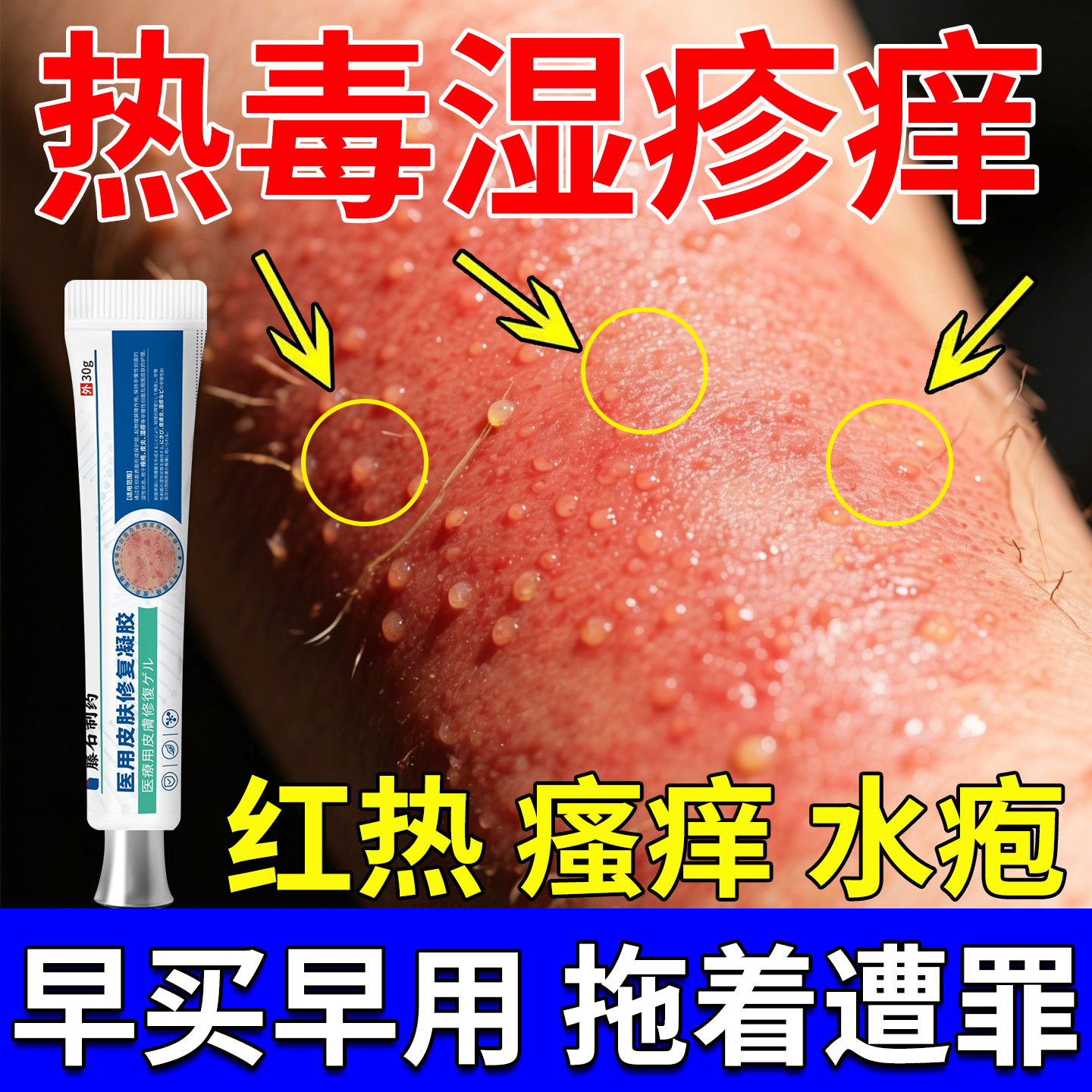 热毒血热湿疹止痒膏皮肤一热就痒去专用除湿根搭湿毒清软膏湿痒OZ