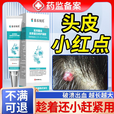 头皮血管瘤血管痔去除普萘洛尔膏