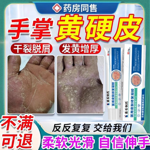 手掌加增厚脓疱草本配方手心发黄变硬干裂脱皮疼痛掌跖拓角化症BS