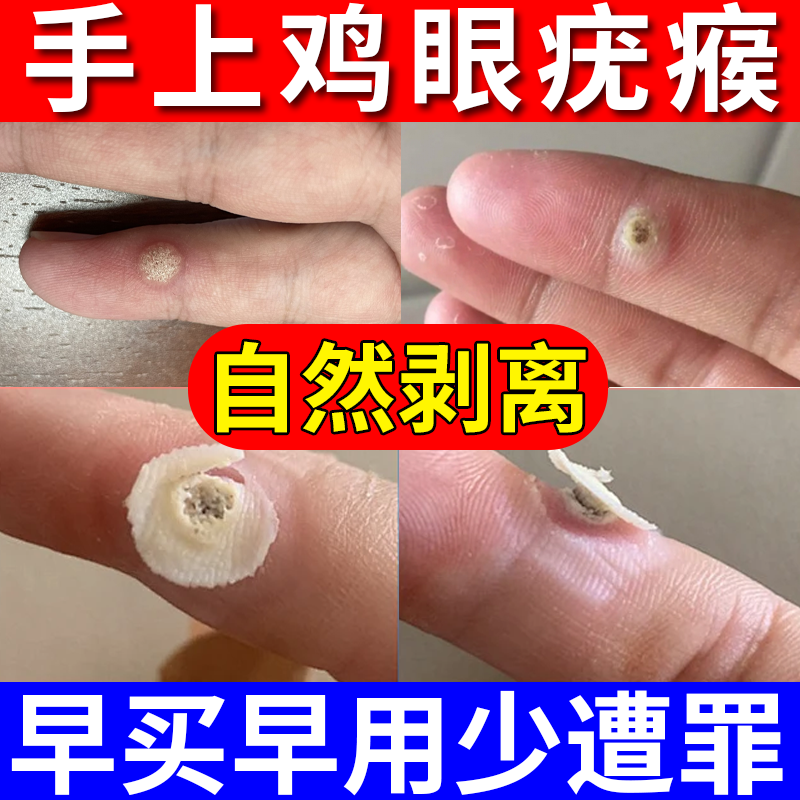 手指寻常疣除手上刺猴瘊子猴子去疣祛疣根神器去除鸡眼贴医用级JW
