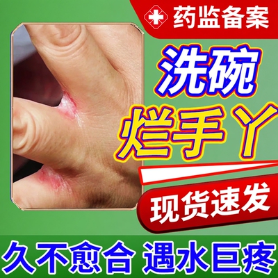 洗碗烂手丫溃烂发白瘙痒专用膏