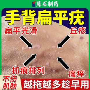 手上手背扁平疣去除膏一抹灵搭干扰素b2凝胶专用药房款软膏去疣OZ