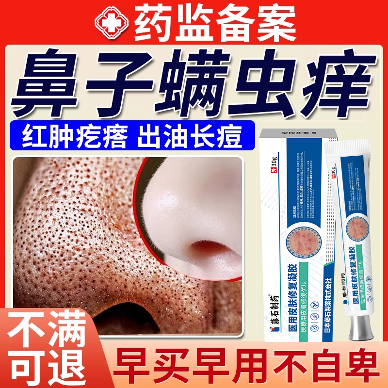 鼻子去除螨虫神器鼻头痒脸部酒糟鼻专用痤疮护肤药房同售止痒膏BS