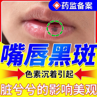 嘴唇黑斑去除淡化唇炎专用祛唇周黑痣黑色素沉淀修复薬监备案膏BS