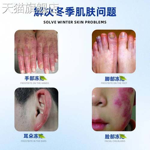 旗舰店官方正品手足冻疮膏护理滋润脱皮脚后跟干裂皮肤抖音快手礼