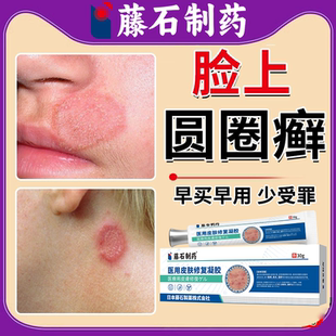 脸上长癣猫藓人用圆圈红斑真菌感染体癣止痒去专用顽固皮炎根BS
