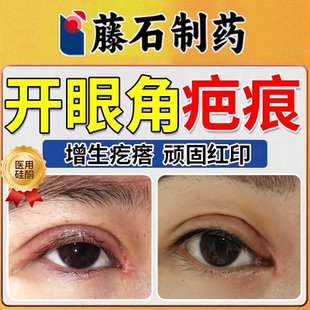 医用开内眼角疤痕全切割双眼皮增生贴修复凸起疙瘩手术后祛疤膏DZ