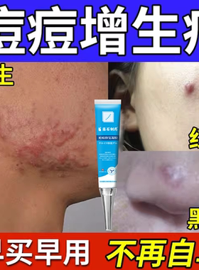 脸上痘痘增生疤痕凸起硬疙瘩胸口痘印痒修去祛除黑色素沉淀复BS