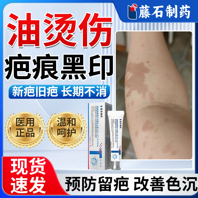 油溅热油烫伤烧伤疤痕修复去红印黑疤印色素沉淀医用祛疤除疤膏BS