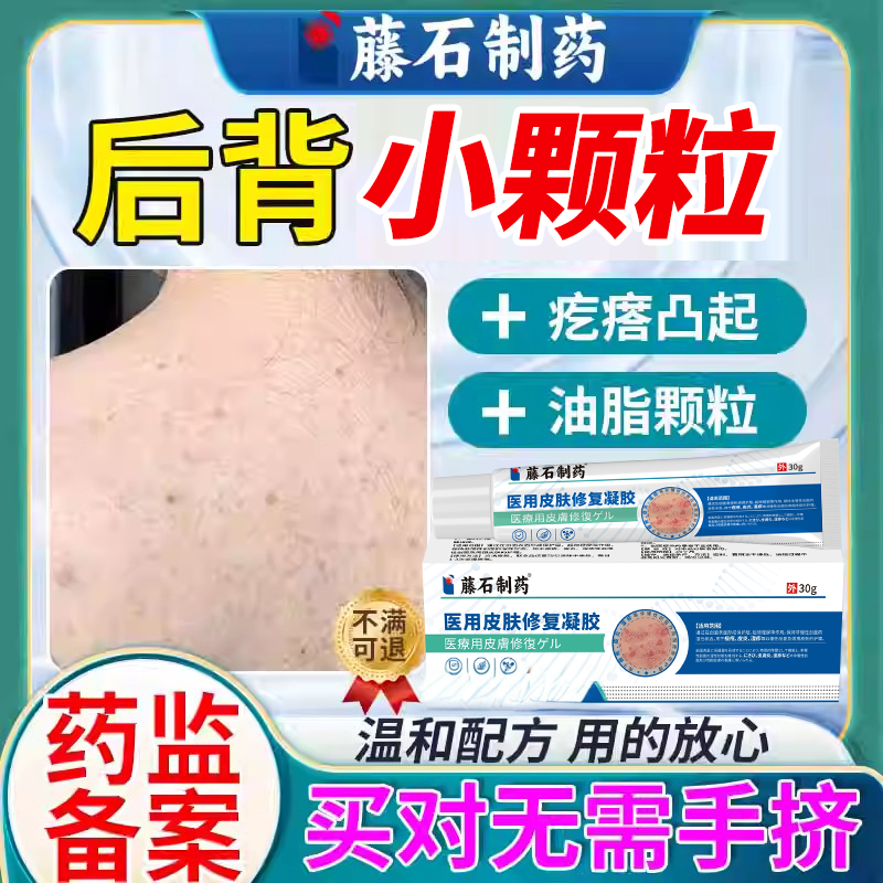 后背脂肪粒去疙瘩小米粒毛周角化毛囊炎背后长痘痘神器去除手臂EM
