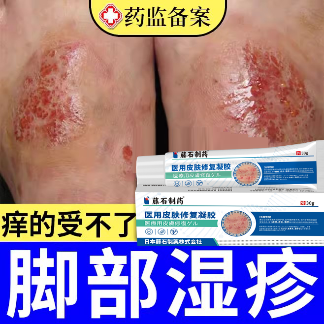 【脚部瘙痒】脚部湿疹痒