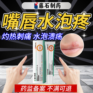 嘴唇疱疹嘴巴上火起水泡烂嘴角特口唇效藤石制薬单纯带状疱疹膏DZ