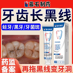 牙齿黑线去除龋齿防蛀抗敏含氟成人蛀牙专用可搭修复牙膏医用型JW