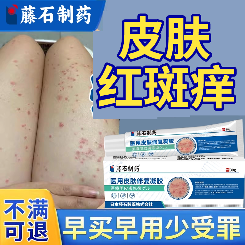 点滴状银屑病红斑鳞屑瘙痒