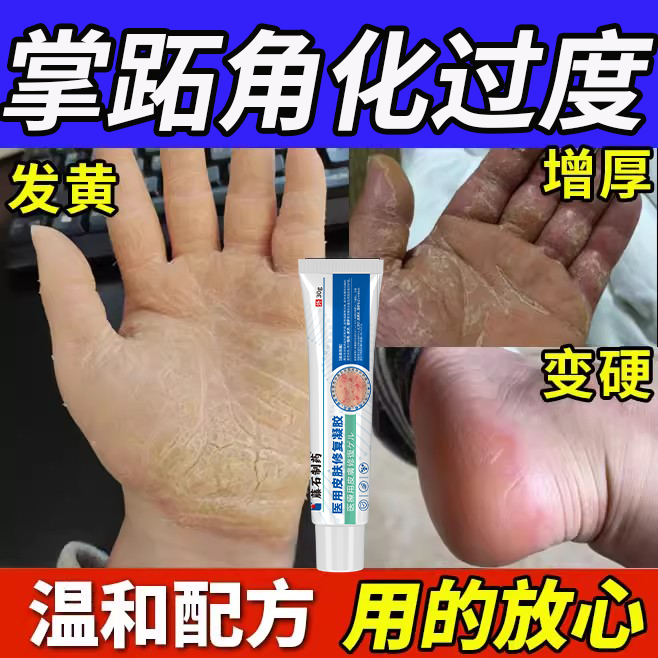 掌趾掌跖角化症手掌脚掌发黄增厚脱皮硬皮干裂脓包病角化专用膏MP