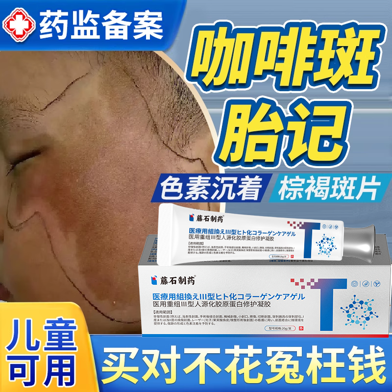 牛奶咖啡斑胎记去除儿童咖啡斑药监备案神经纤维瘤祛斑膏防晒贴EM