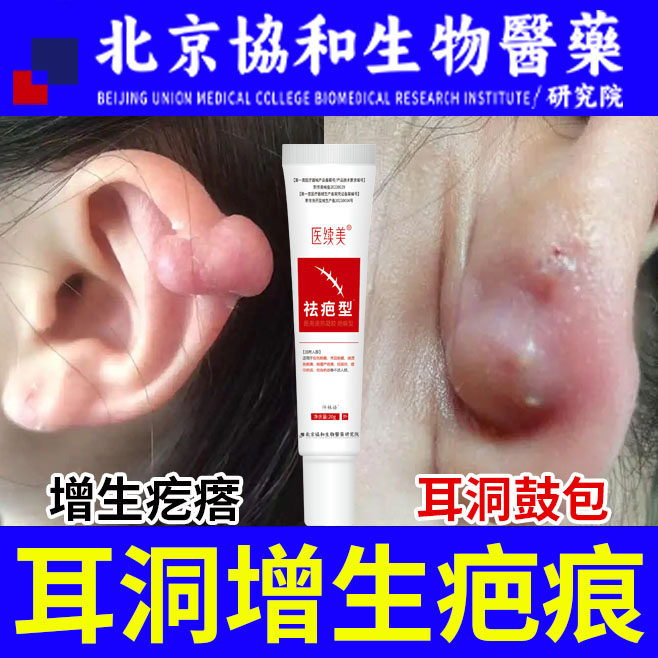 耳洞增生疤痕疙瘩凸起祛疤膏贴止痒硬肉去除软化针修复肉球发炎yr