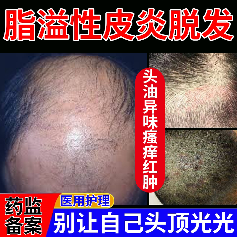 头皮屑和头皮癣的区别,头皮屑和头皮癣的图片(第8页)_大山谷图库