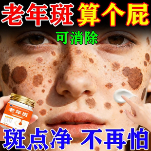 祛斑霜官方旗舰店正品第一名去老年祛黄褐斑老年斑强力去除专用膏