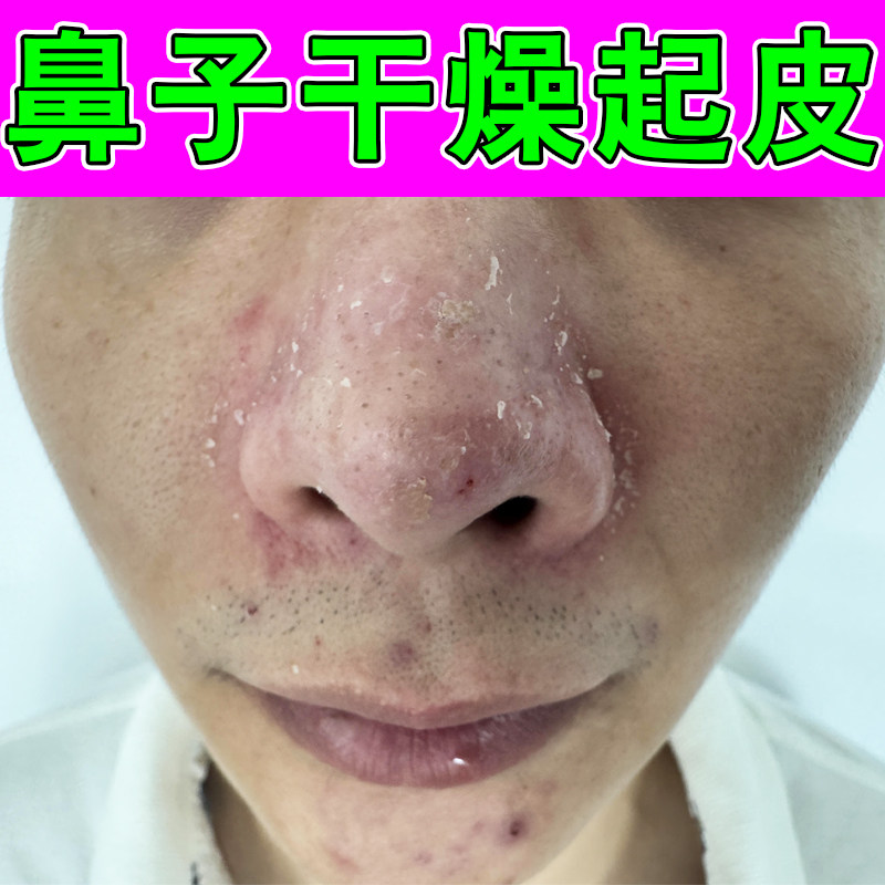 鼻子干燥起皮掉屑红鼻头毛囊堵塞鼻翼两侧泛红修复粗糙掉皮专用膏