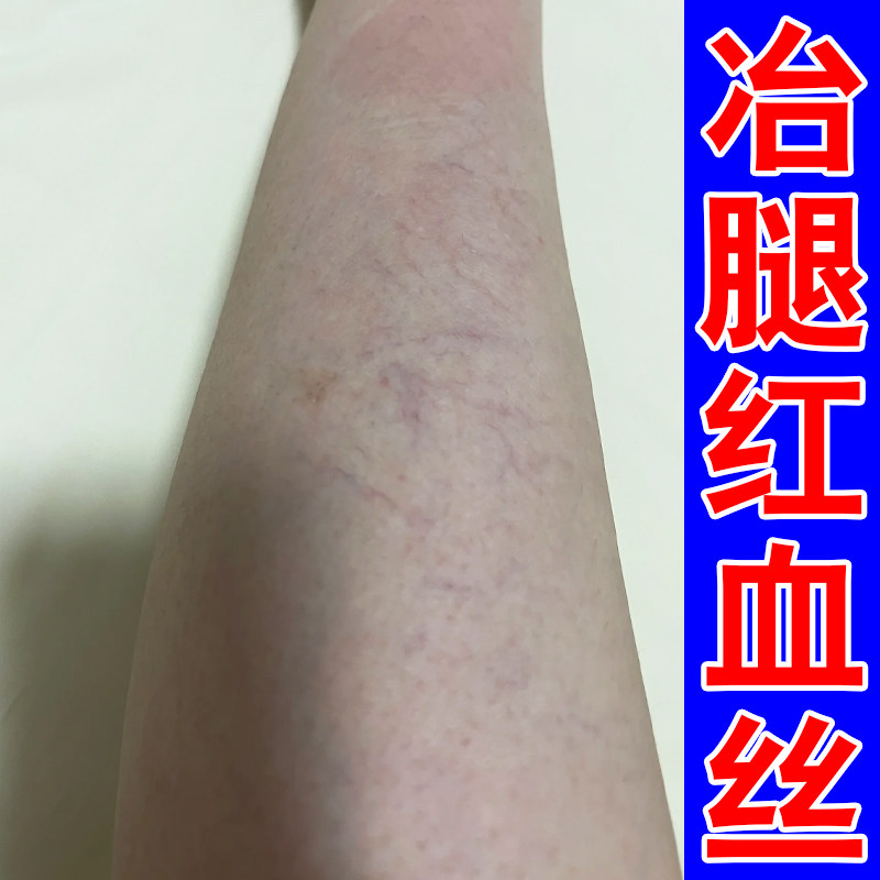 冶腿上有红血丝药毛细血管扩张腿部下肢血管不流通疏通青筋凸起膏