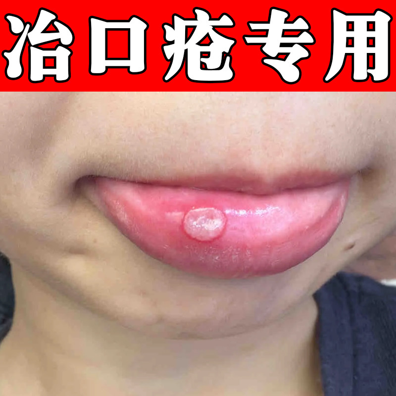 冶嘴巴内壁长白斑专用喷剂口腔黏膜念珠菌疼痛内壁圆形白泡红肿