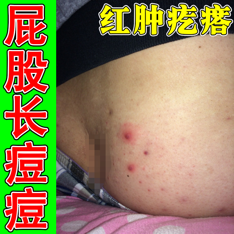 屁股长痘痘红肿疙瘩火疖子热疙瘩久坐板慢性股大腿内侧痒专用膏药
