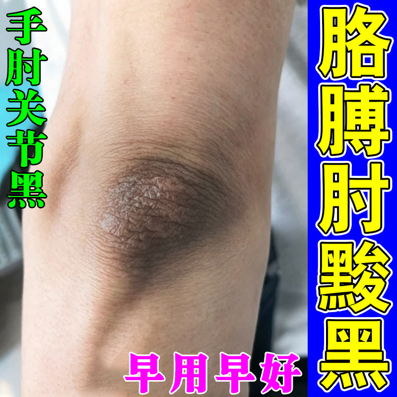 去胳膊肘黑死皮手肘干燥粗糙除脖子黑色素沉淀关节皮肤黑洗不干净