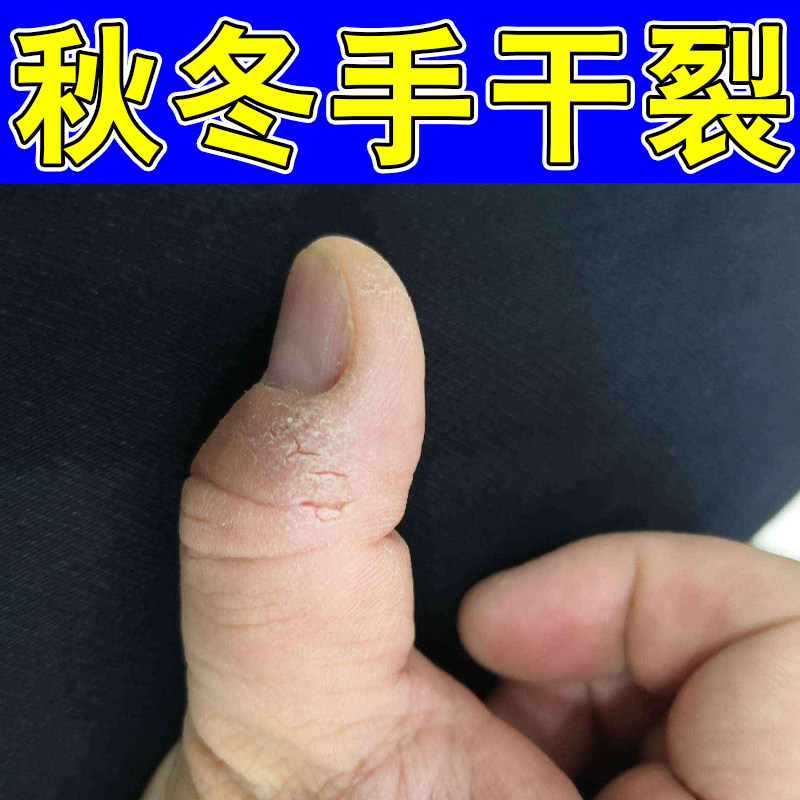 秋冬手干裂粗糙起硬皮掉屑改善脚后跟干裂修复霜真菌手裂口子脱皮