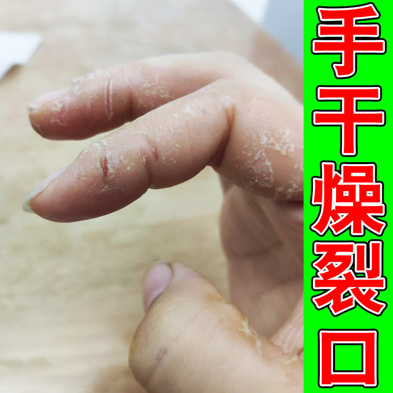 手指头干燥裂口子药真菌手脱皮起皮粗糙干痒手脚后跟干裂修复霜膏