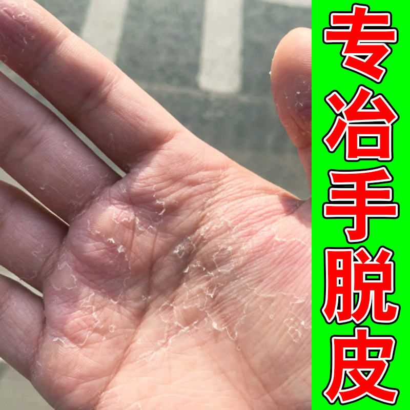 专冶手脱皮的药手掌手指手心起皮掉屑手脚干燥粗糙硬皮蜕皮专用膏
