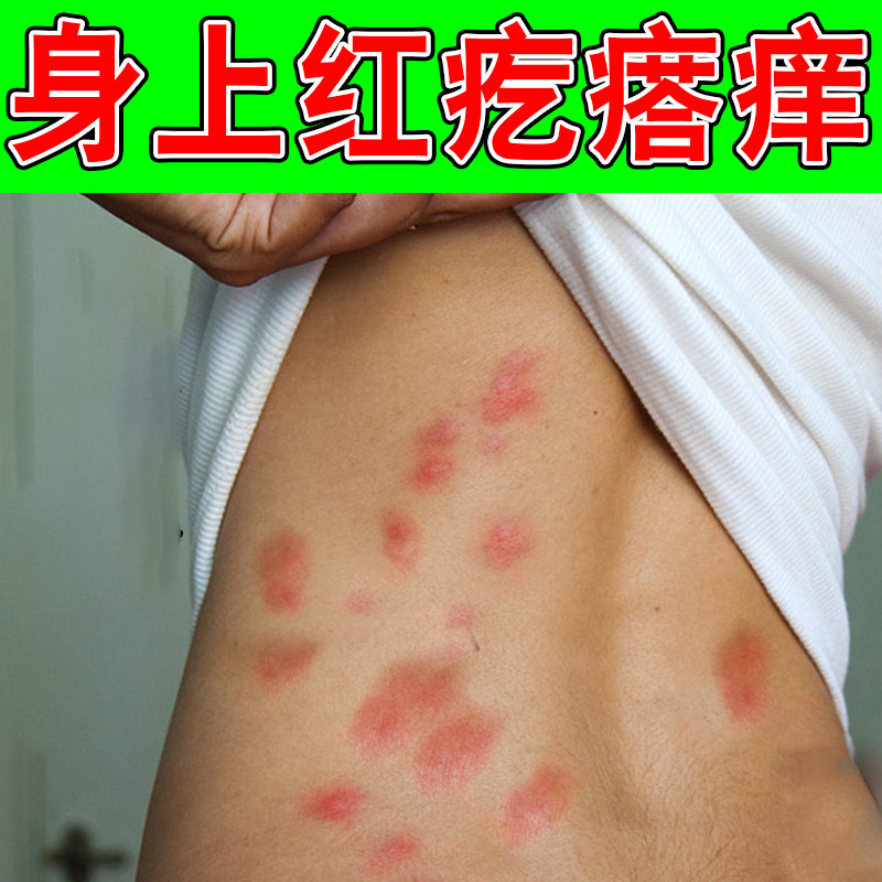 身上起红疙瘩痒红肿脓包痒夏天蚊虫叮咬皮肤痒长小红点痘痘修复